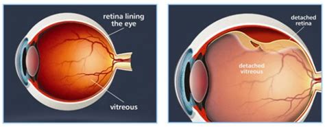 Retinal detachment - Evershine Optical