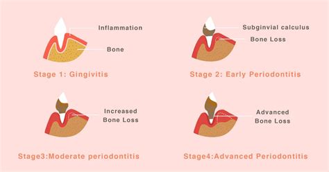 How To Prevent Your Dog From Getting Periodontal Disease