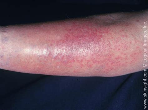 Stasis Dermatitis | Causes | Treatment | Symptoms | Pictures