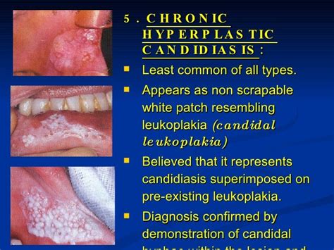 Bacterial, Viral & Mycotic Infections