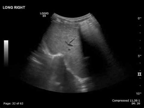 Paradoxical Diaphragm Motion on Ultrasound - YouTube