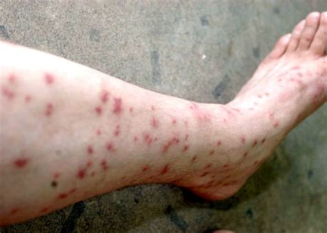 Flea Allergy in People: To Treat or Not to Treat?