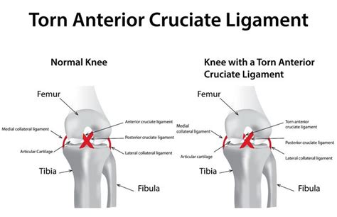 ACL Injury(ACL Tear) – Symptoms and Causes | New Life Ticket - Part 7