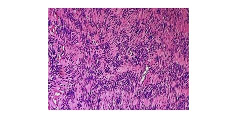 Pathology of Schwannoma - Pathology Made Simple