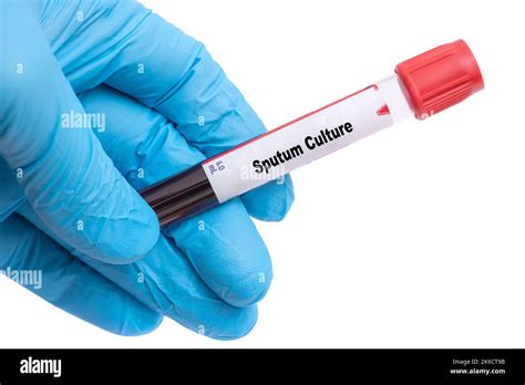 Sputum Culture Medical check up test tube with biological sample Stock Photo - Alamy