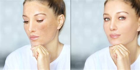 Skin Discoloration: Causes & Solutions | Blog -Topicals