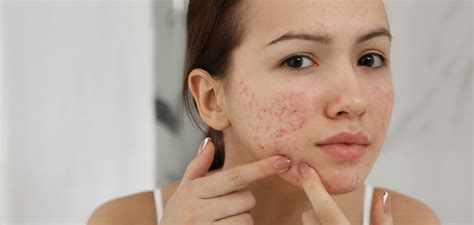 Your guide to understanding hormonal acne | Happiest health