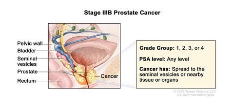 Prostate Cancer Treatment - NCI