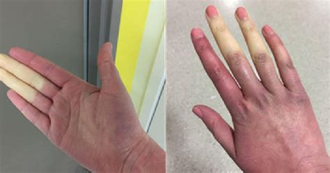 What is Raynaud's disease? The disorder that causes white or blue fingers, toes