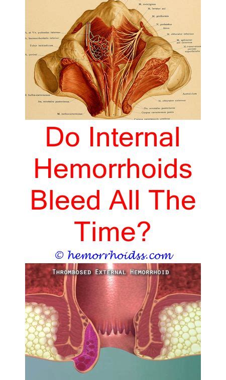 How Much Is Hemorrhoid Surgery? | Hemorrhoids treatment, Bleeding hemorrhoids, Cure for hemorrhoids