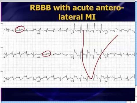 Weekly ECG case studies, discussed on YouTube, by Dr. Amal Mattu, an ...