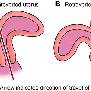 Retroverted Uterus Pregnancy