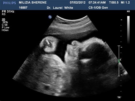 Days of our lives...: 32 weeks Ultrasound