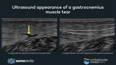 Gastrocnemius Tear Ultrasound