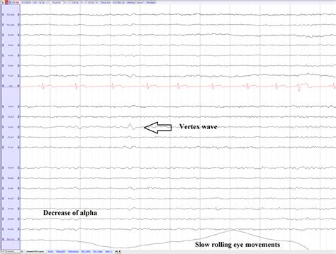 Vertex waves - EEGpedia