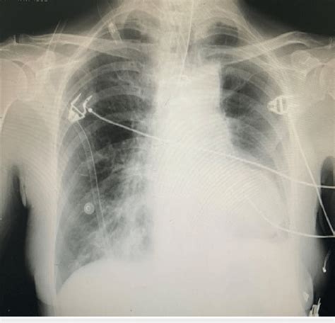 Post-intubation chest x-ray | Download Scientific Diagram