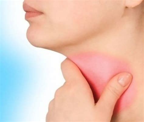 Sore throat and Swollen glands - Causes and Treatment | HubPages