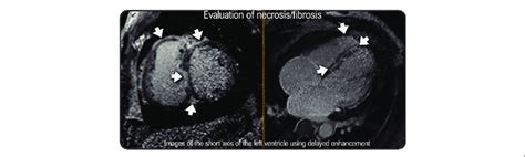 -Cardiac magnetic resonance imaging of a patient with alcoholic... | Download Scientific Diagram