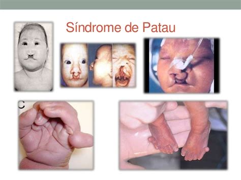 Doença Genética: Síndrome de Patau ou Trissomia do 13: Síndrome de Patau ou Trissomia do 13