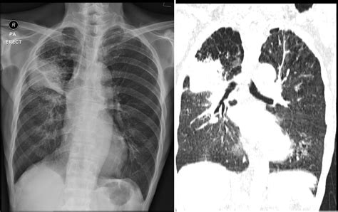 Non-small cell lung cancer: Adenocarcinoma – Radiology Cases