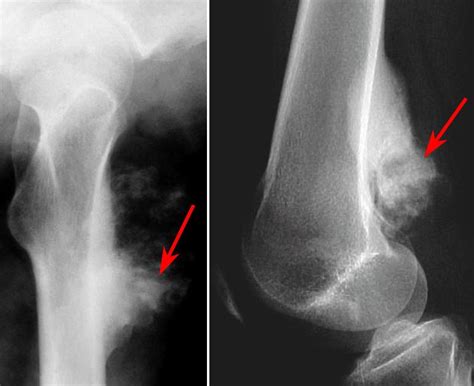 Osteosarcoma - OrthoInfo - AAOS