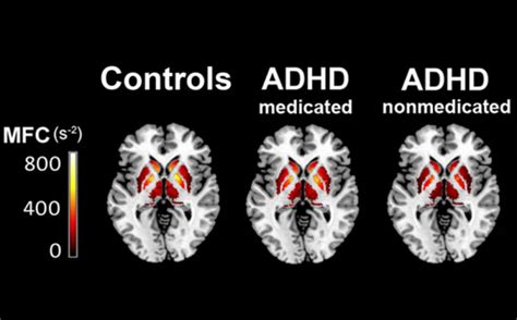 What Is ADHD Brain? Learn ADHD Brain Vs Normal Brain.