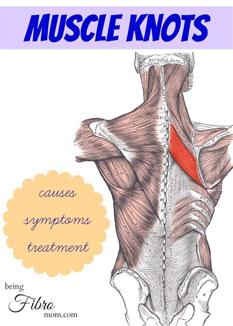 muscle knots - causes, symptoms, and treatments http://www ...