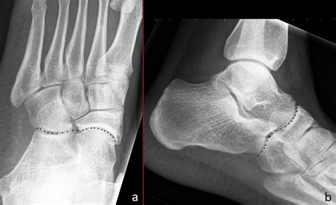 Fractures of the Cuboid Bone: A Critical Analysis Review : JBJS Reviews