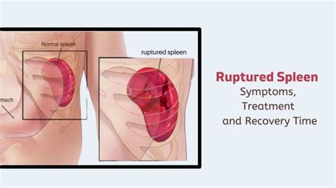 Ruptured Spleen : Symptoms,Treatment and Recovery Time - VIMS