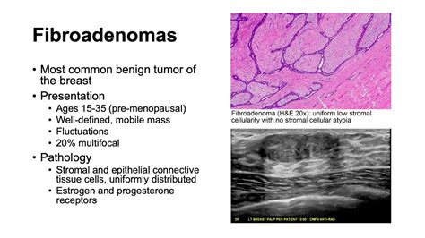 Fibroadenomas and Phyllodes Tumors - YouTube