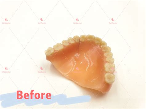 Professional Denture & Partial Repair | Etsy