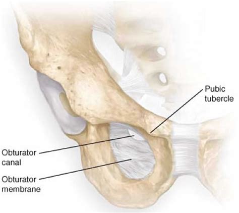 Obturator hernia – Artofit