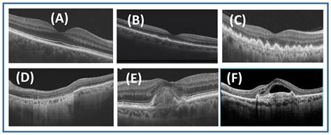 Macular Degeneration Oct