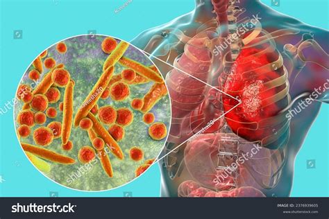 Microscopic View Mycoplasma Genitalium Mgen Tiny Stock Photo 2376939605 ...