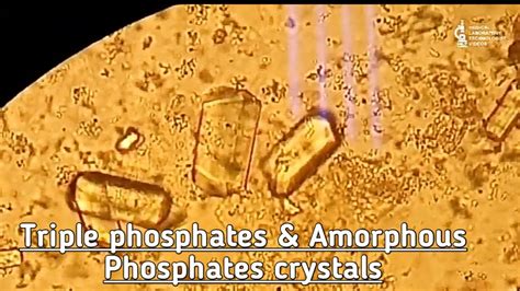 Amorphous Phosphate Crystals In Urine