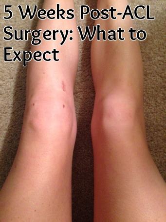 ACL Post-Surgery Week 5 - Nina Elise