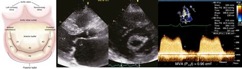 Valvular Emergencies: Diagnosis and Management of Severe Mitral Stenosis | RECAPEM