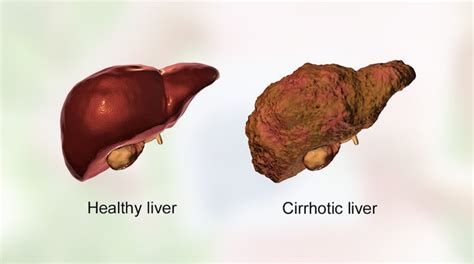 Cirrhosis of Liver - Dr Pathik Parikh Liver Specialist