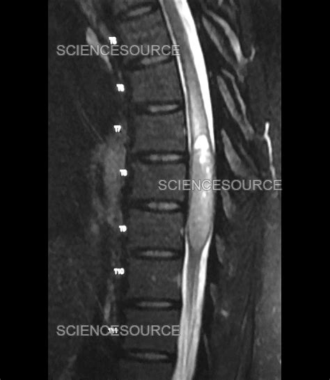 Thoracic Spinal Cord Ependymoma, MRI | Stock Image - Science Source Images