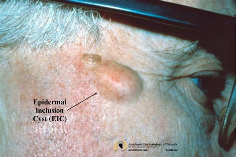 Epidermal Inclusion Cysts (EIC): Epidermoid Cysts... - Academic ...