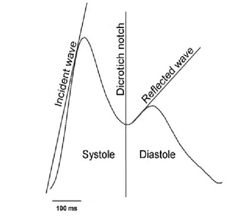 Morphological features of the pulse signal. The incident wave is formed... | Download Scientific ...