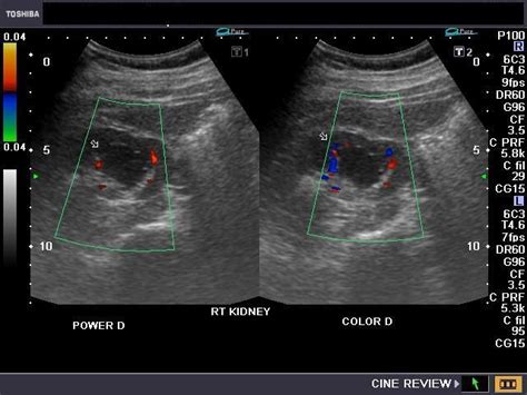 Calyceal diverticulum or calyceal cyst The above B-mode ultrasound ...