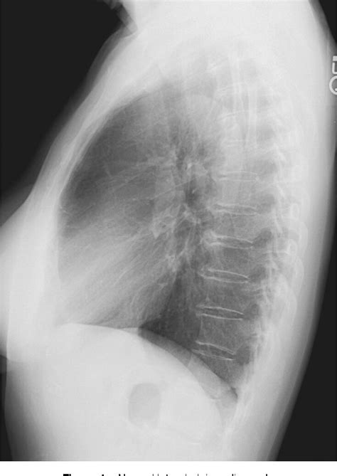 Figure 5 from Lateral chest radiograph a systematic approach ...