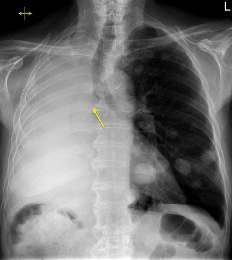 Metastatic Lung Cancer - CancerWalls