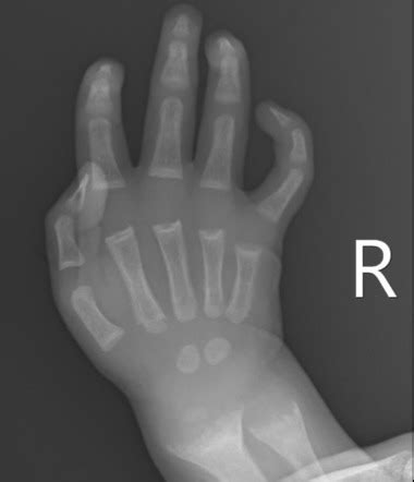 Rickets Disease X Rays