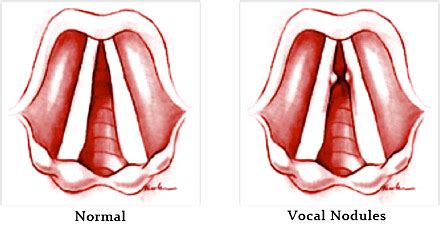 Muscle Tension Dysphonia – Voice Problem