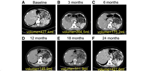 Target Renal Angiomyolipomas of a Patient with the Tuberous Sclerosis... | Download Scientific ...