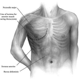 Lung cancer Flashcards | Quizlet