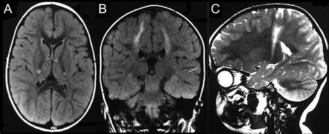 Krabbe Disease - Causes, Symptoms, Life Expectancy, MRI, Treatment