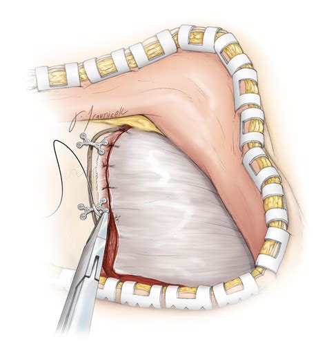 Pterional Craniotomy | The Neurosurgical Atlas